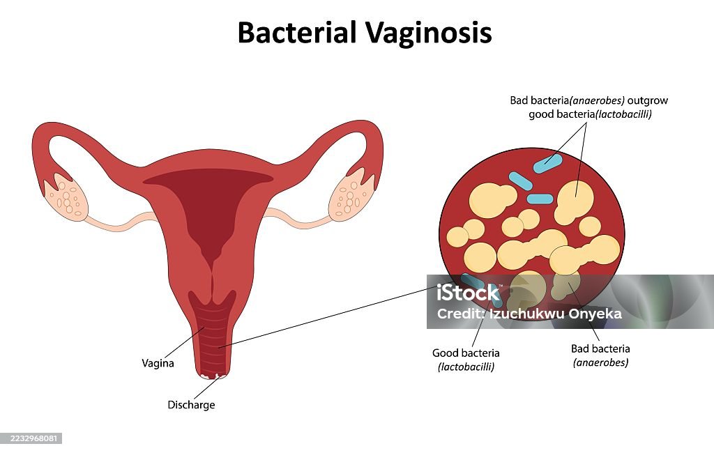 Diagram illustrating Bacterial Vaginosis.